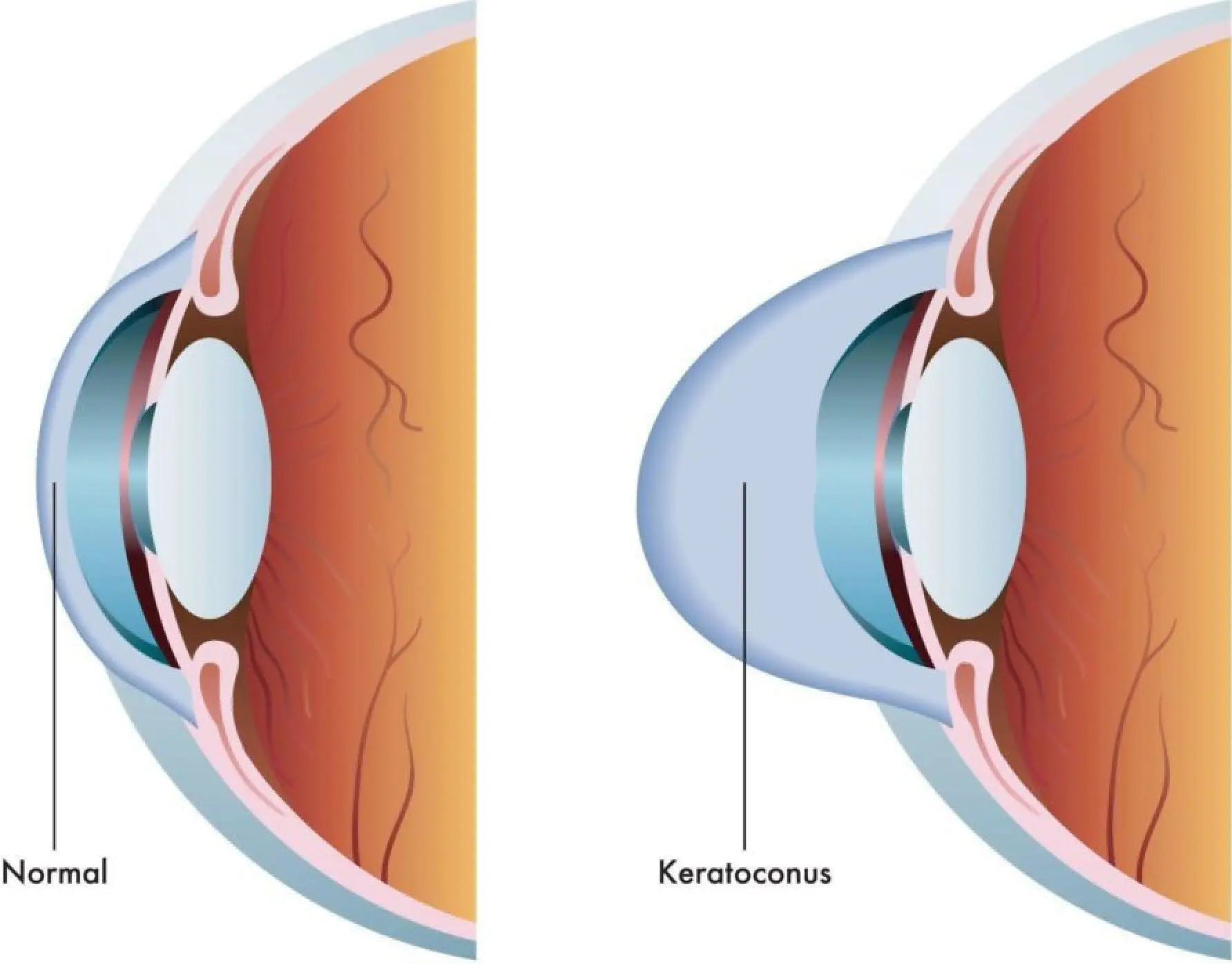 Keratoconus comparison.